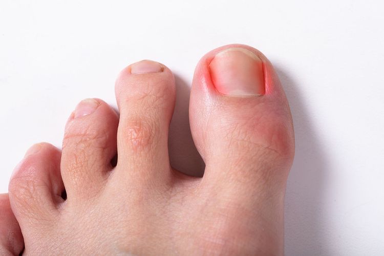 Ingrown Toenails: Everything you need to know.